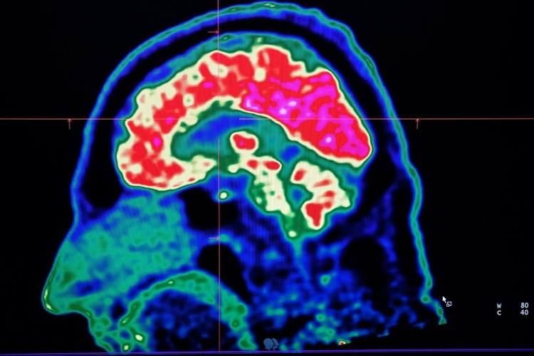 Studie: neurologische Erkrankungen klettern an Spitze verbreitetster Krankheiten