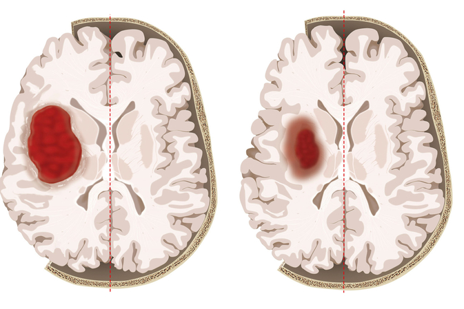 Neue Therapie bei Schlaganfall