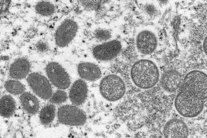 Sprunghafter Anstieg der Mpox-Infektionen im Kongo - WHO befrchtet Ausbreitung
