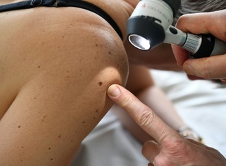 Krankenkasse: Deutlicher Anstieg bei Hautkrebspatienten