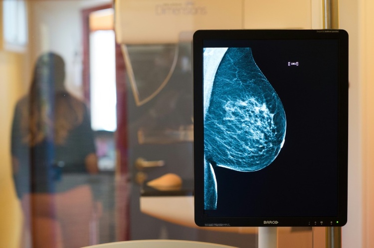 Mammografie: Altersgrenze für Brustkrebs-Früherkennung wird herabgesetzt